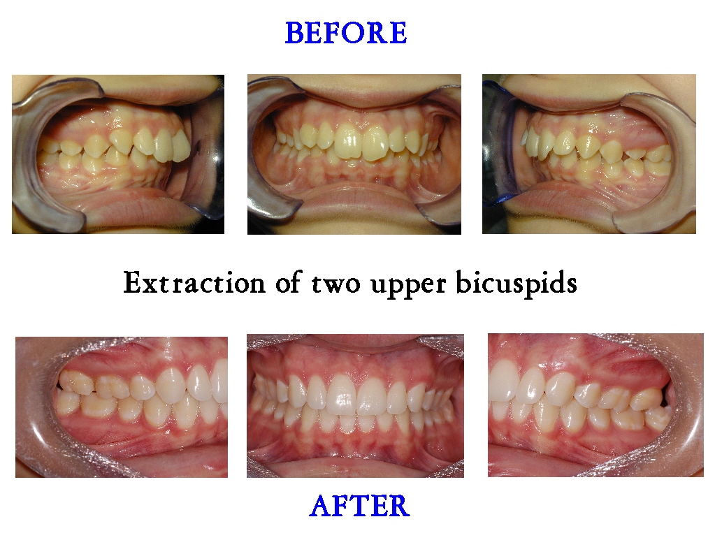 Extraction of 2 bicuspids