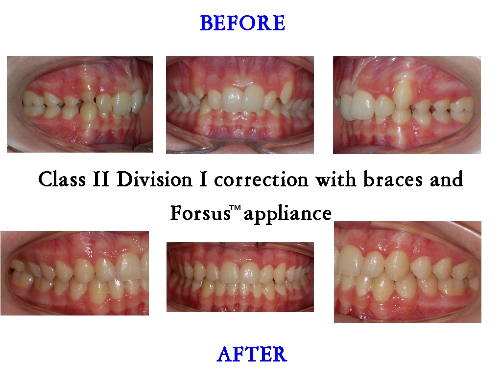 Class 2 Division 1 Forsus